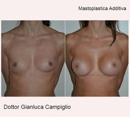 mastoplastica additiva Dottor Gianluca Campiglio