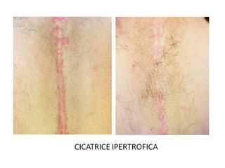 cicatrici prima dopo