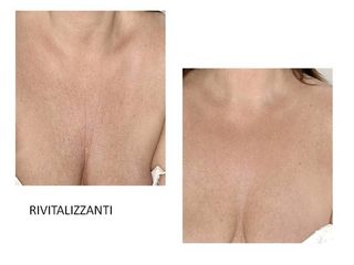 mesoterapia prima dopo