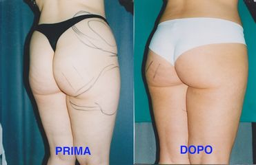 Liposuzione prima e dopo