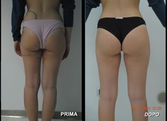 Lipofilling prima e dopo