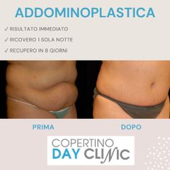 Addominoplastica - Dott. Luigi Nestola