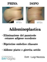 Addominoplastica - Dott. Luigi Nestola