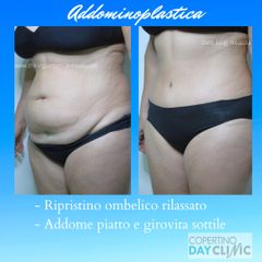 Addominoplastica - Chirurgia Estetica Nestola - Dott. Luigi Nestola