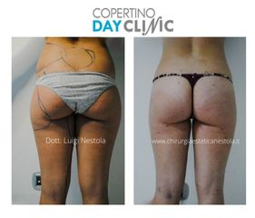 Liposuzione - Chirurgia Estetica Nestola - Dott. Luigi Nestola