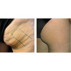 Cellulite prima e dopo