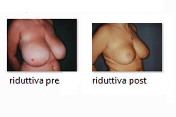 Mastoplastica riduttiva