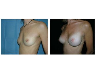 Mastoplastica additiva pre e post