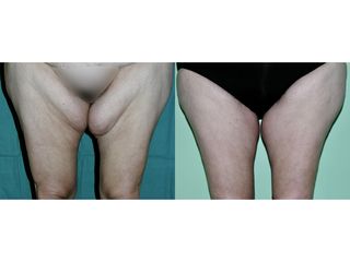 Lifting cosce - Dr. Pier Luigi Gibelli