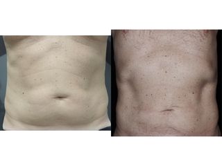 Liposuzione - Dr. Pier Luigi Gibelli