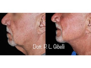 Lifting viso e collo - Dr. Pier Luigi Gibelli