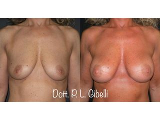 Mastoplastica additiva - Dr. Pier Luigi Gibelli