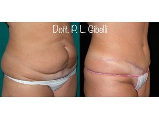 Addominoplastica - Dr. Pier Luigi Gibelli