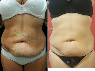 prima e dopo Coolsculpting