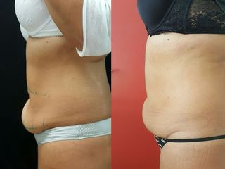 prima e dopo Coolsculpting addome