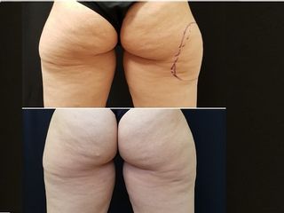 Cellulite prima e dopo