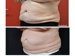 addome prima e dopo