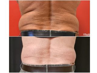 Addome prima e dopo