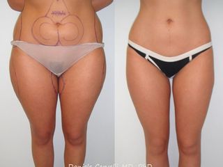 liposuzione prima dopo