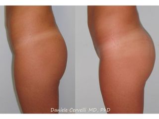 Gluteoplastica additiva prima dopo