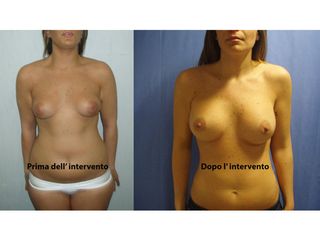 mastoplastica additiva prima dopo