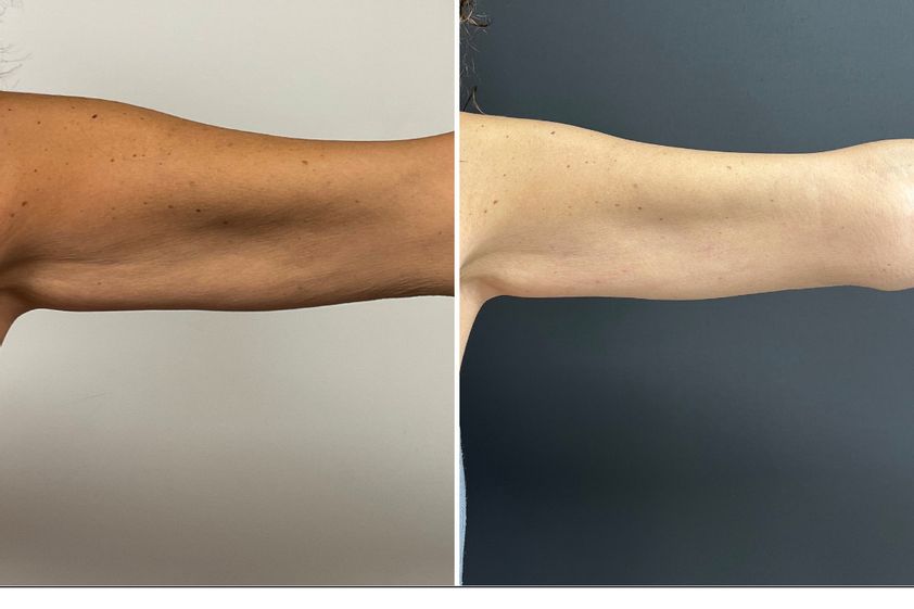 Cellulite prima e dopo - 864809