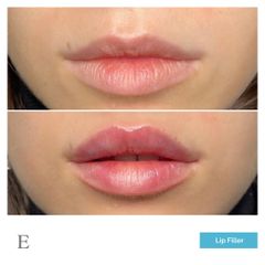 Lip filler - Medicina Estetica Equilybra