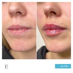 Lip filler Carducci - Medicina Estetica Equilybra