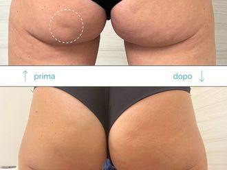 Cellulite prima e dopo - 866281