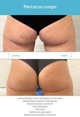 Cellulite - Medicina Estetica Equilybra