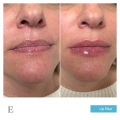 Lip filler - Dott.ssa Anna Elisa Velardi