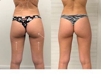 Cellulite prima e dopo - 866938