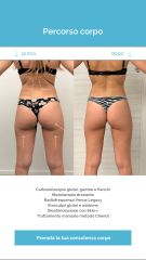 Cellulite e Tonificazione - Medicina Estetica Equilybra