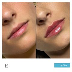 Lip Filler - Dott. Francesco Carducci