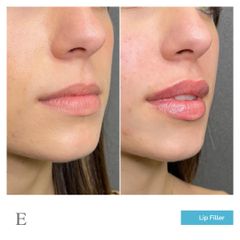 Lip filler - Dott. Francesco Carducci, Equilybra Medical Beauty Center