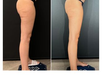 Cellulite prima e dopo - 870522