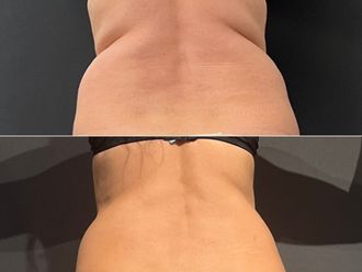 Criolipolisi prima e dopo - 871852