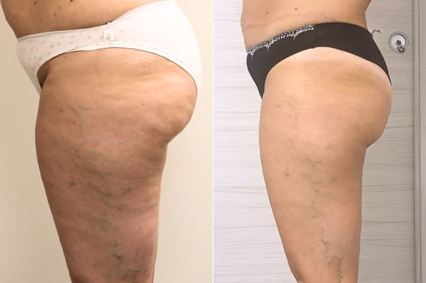 Criolipolisi prima e dopo - 872959