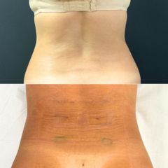 Equilybra Medical Beauty Center Miniliposuzione