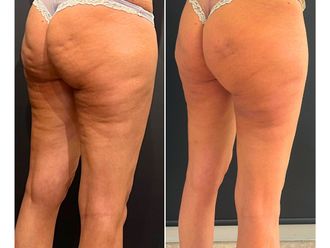 Cellulite prima e dopo - 873729