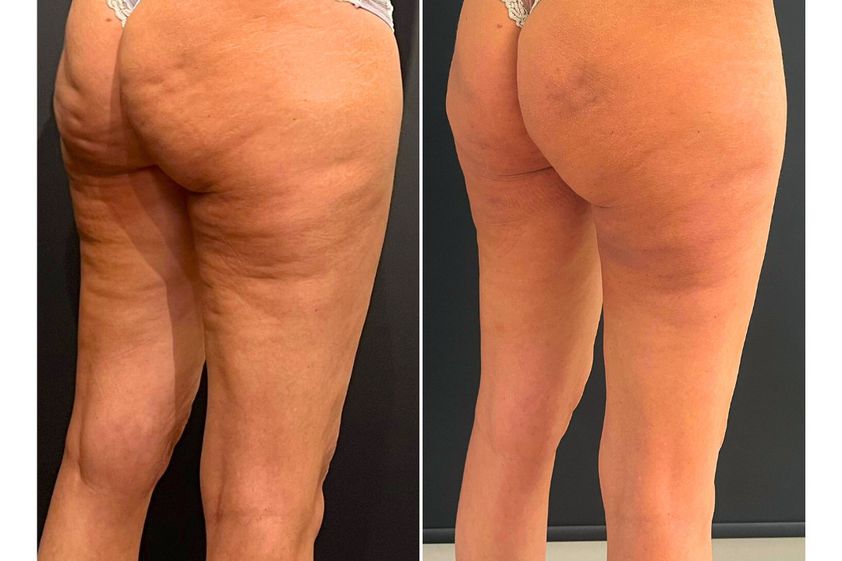 Cellulite prima e dopo - 873729