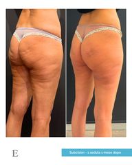 Equilybra Medical Beauty Center Subcision