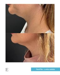 Equilybra Medical Beauty Center FaceTite