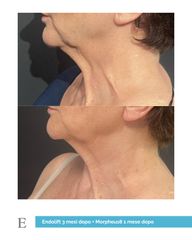 Equilybra Medical Beauty Center Morpheus8 ed Endolift