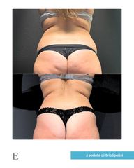 Equilybra Medical Beauty Center Criolipolisi.