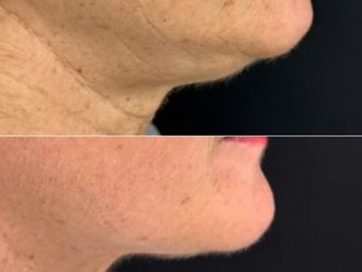 Needling prima e dopo - 874780