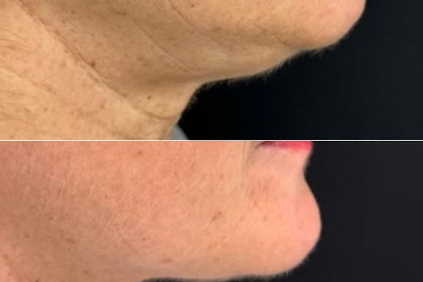 Needling prima e dopo - 874780