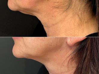 Laserterapia prima e dopo - 874925