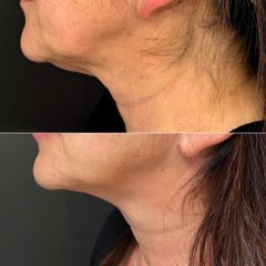 Equilybra Medical Beauty Center Dott.ssa Cristiana Saporosi Endolift + Morpheus8