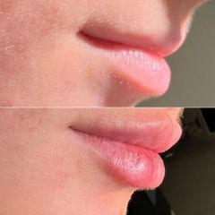 Equilybra Medical Beauty Center LipFiller